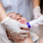 The Benefits of Combining Microneedling With Other Treatments