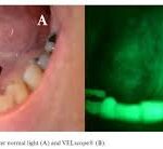 How a Dermatologists Approach Early Detection in Squamous Cell Carcinoma