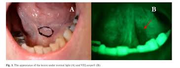 How a Dermatologists Approach Early Detection in Squamous Cell Carcinoma