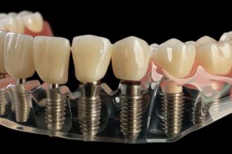 What to Expect During a Dental Implant Procedure