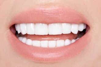 What to Expect When Getting Porcelain Veneers