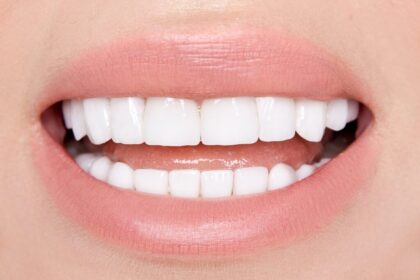 What to Expect When Getting Porcelain Veneers