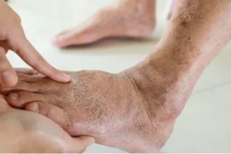 Awareness and Prevention of Deep Vein Thrombosis in Active Lifestyles