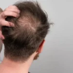 Comparing Different Hair Loss Treatment Options and Their Effects