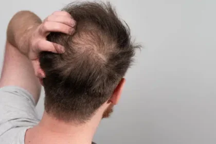Comparing Different Hair Loss Treatment Options and Their Effects