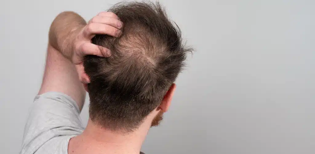 Comparing Different Hair Loss Treatment Options and Their Effects