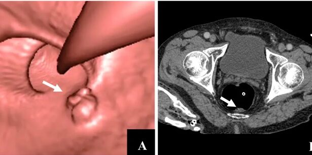 Guidelines and Recommendations for Scheduling Your Colonoscopy
