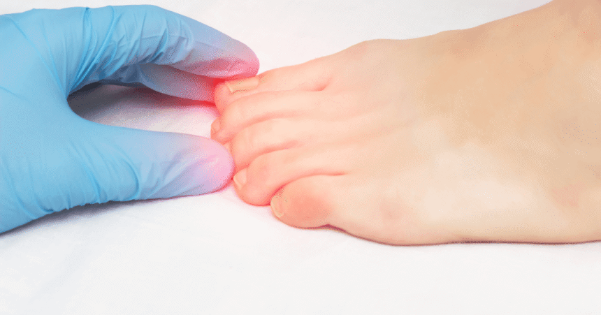 How To Manage Pain From Ingrown Toenails