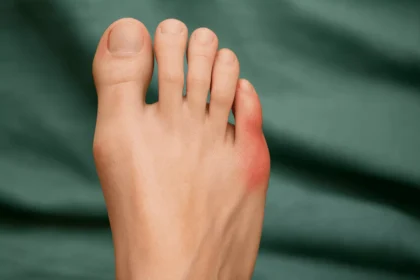 Understanding the Impact of Bunions on Your Daily Activities