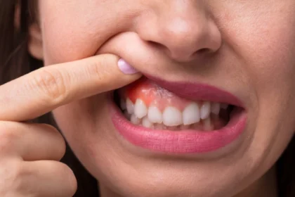 Understanding the Stages of Gum Disease and When you Need Oral Surgery