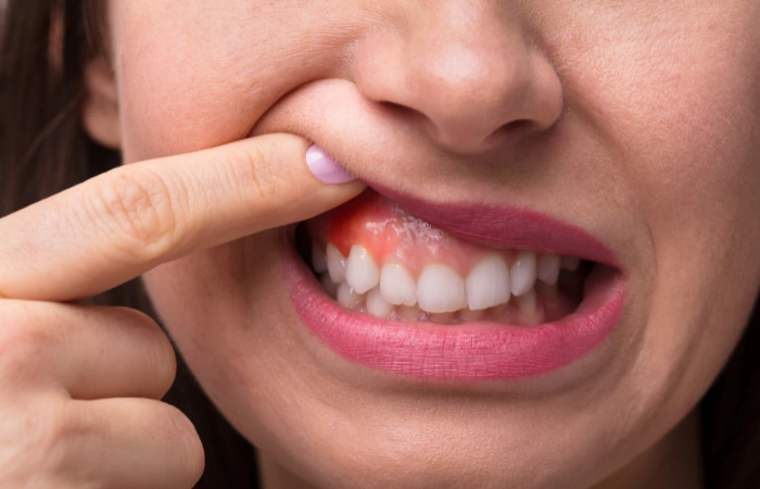 Understanding the Stages of Gum Disease and When you Need Oral Surgery