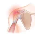 Understanding the Mechanics of a Rotator Cuff Tear