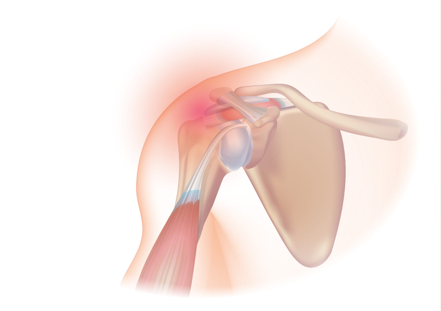 Understanding the Mechanics of a Rotator Cuff Tear