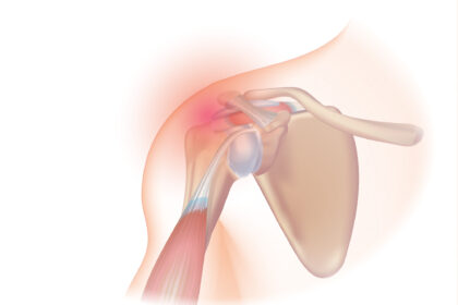 Understanding the Mechanics of a Rotator Cuff Tear